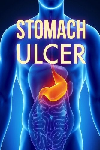Stomach Ulcer Treatment In 60 Days Stomach Ulcer Treatment