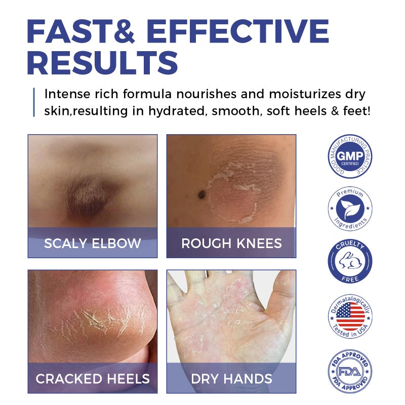 OUKEYA Urea Cream 42% plus Salicylic Acid 2% Intensive Repair Treatment for Cracked Skin on Hands, Heels, Elbows, and Lips - Relief for Dry Feet - Enhanced Pump Dispenser Packaging 2 Pack - Image 5