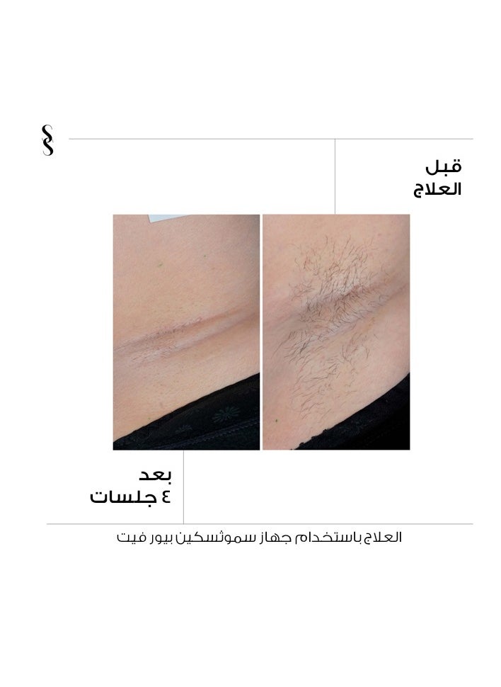 SMOOTHSKIN New Pure Fit Ultrafast Painless IPL Permanent laser hair removal home device and machine for Women & Men - Body & Face,hair removal system,Clinically Tested and FDA Cleared. - pzsku/Z36AA2F588FADFCAE554BZ/45/_/1740904632/9fe00bb0-5048-4ea0-a222-896569d5a066