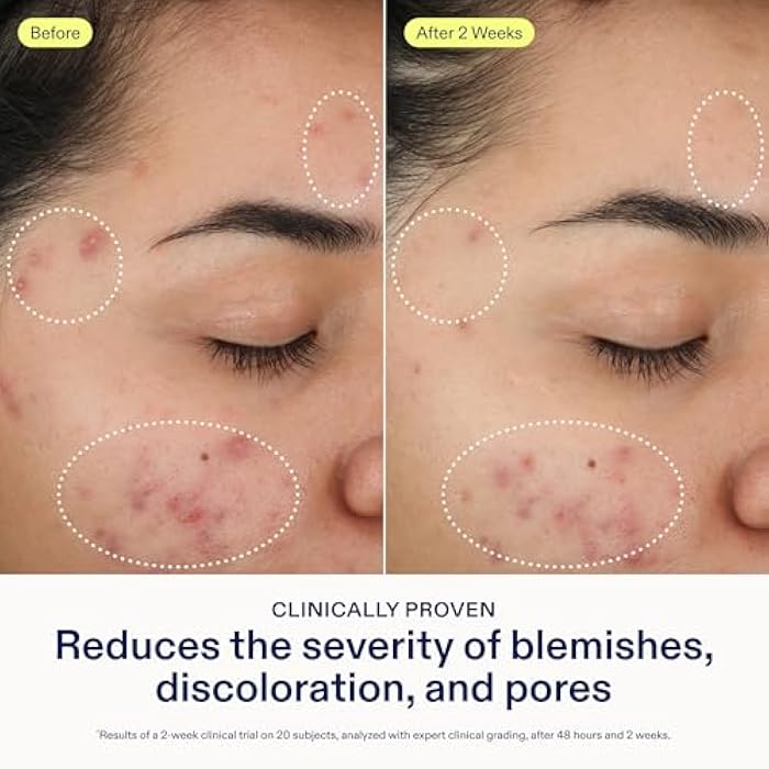 Skinfix 2% BHA Cleanser - 5 oz - Clears Acne Blemishes & Blackheads - Safe for All Types of Acne - Fragrance Free - Vegan, Cruelty Free - Image 4