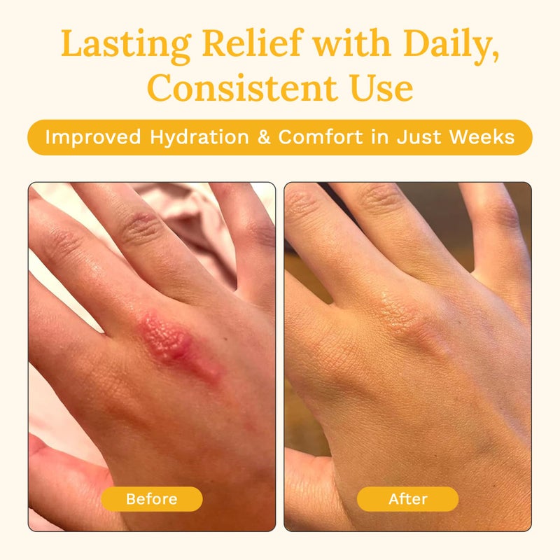 Rejuvaskin Skin Recovery Cream with Aloe Vera, Cooling Moisturizing Cream for Dry, Itchy & Sensitive Skin, 100 ml - Image 5