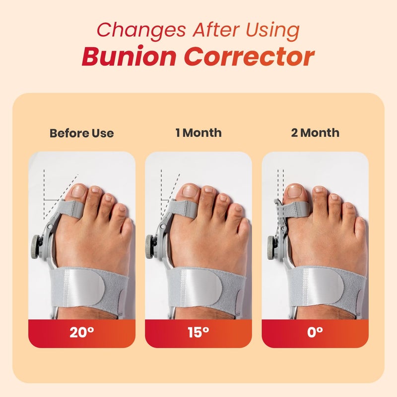 AGEasy Antara Bunion Corrector Orthopedic Toe Straightener with Adjustable Rotating Knob, Universal Fit for both Left and Right Feet (One Size - Pack of 2) - Image 5