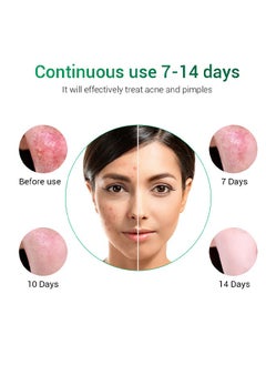 Breylee Acne Treatment Ceam Acne Removal Acne Pimple Repair Cream, Acne Spot Treatment for Face & Acne Dots, Natural Cystic Acne Treatment, For All Skin Types, 20g  - Image 3