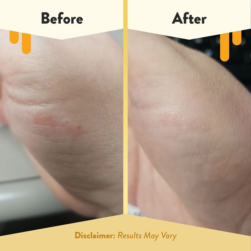 ECZEMA HONEY Itch Cooling Face  Body Rounds - Anti Itch Cotton Face Pads - Moisturizer for Eczema, Dry  Sensitive Skin (50 Cotton Rounds) - Image 4