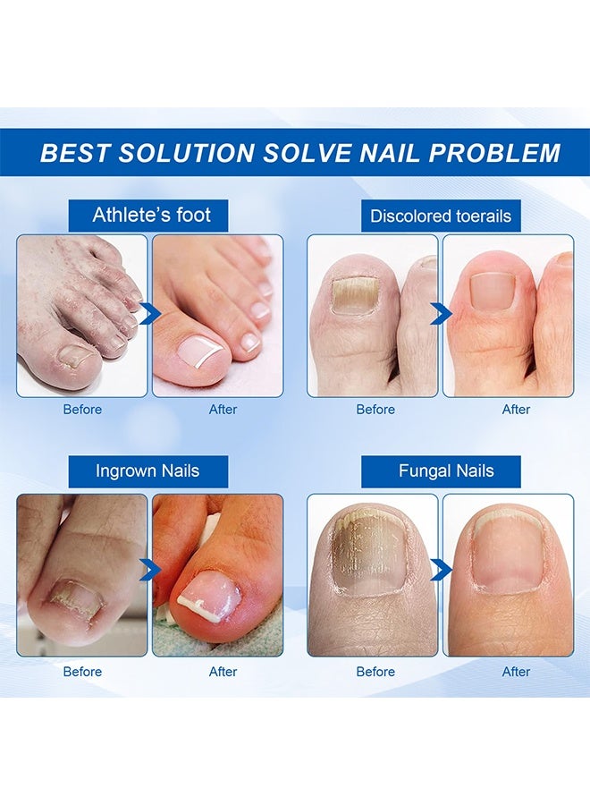 Sefudun Removal Paronychia Oil,Toenail care Ingrown Toenail Nail Repair Toenail Plus Anti Paronychia Relief Oil Nail Renewal Liquid for Damaged and Discoloration Nail Swelling and Pain removal Oil 30ml  - Image 5