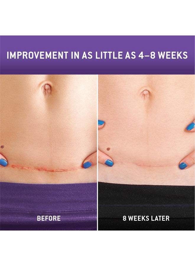 Care Science C Section Recovery Silicone Scar Sheets 1.5in x 7in 8ct | Reuseable Scar Sheets for Reducing the Appearance of C-Section, Keloid, and Acne Scars - Image 2