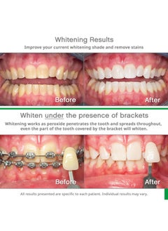 Opalescence Opalescence Go 15- Prefilled Teeth Whitening Trays - 15% Hydrogen Peroxide - (10 Treatments) Made by Ultradent Products. Teeth Whitening Kit -Mint - 5194-1  - Image 5