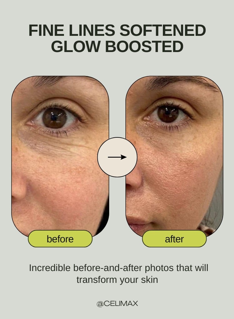 celimax The Vita-A Retinal Shot Tightening Booster 15ml | Advanced Retinal Serum with Firming, Smoothing, Anti-Wrinkle, and Skin Renewal Benefits - Image 3