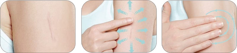 Mederma Skin Care (Helps Scars -Surgery, Injury, Burns, Acne,Stretch marks) - Image 3