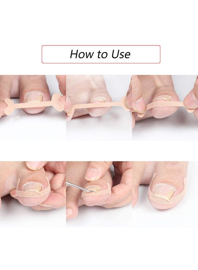 Ingrown Toenail Treatment Strips, 20 Pcs Toe Nail Correction Patch Elastic Patch Sticker Corrector Pedicure Tools Fingernail Toe Nail Care - Image 4