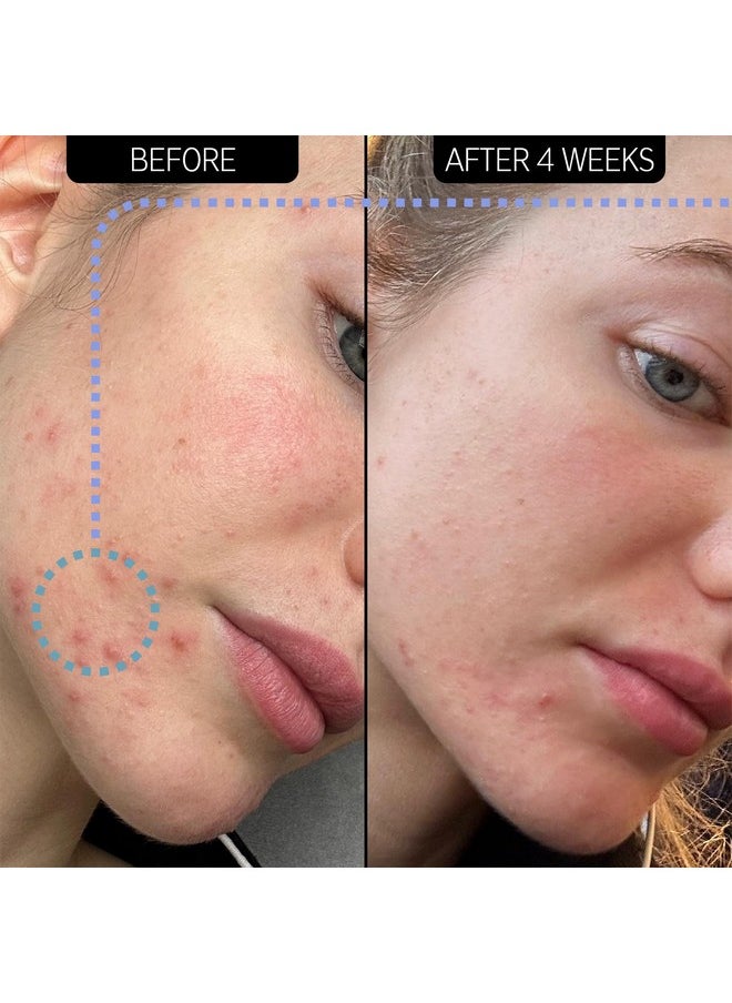 The Inkey List Supersolutions Novoretin 2% Moisturizer Skin Clearing Moisturizer To Reduce Blemishes And Breakouts While You Sleep Noncomedogenic 1.69 Fl Oz  - Image 2