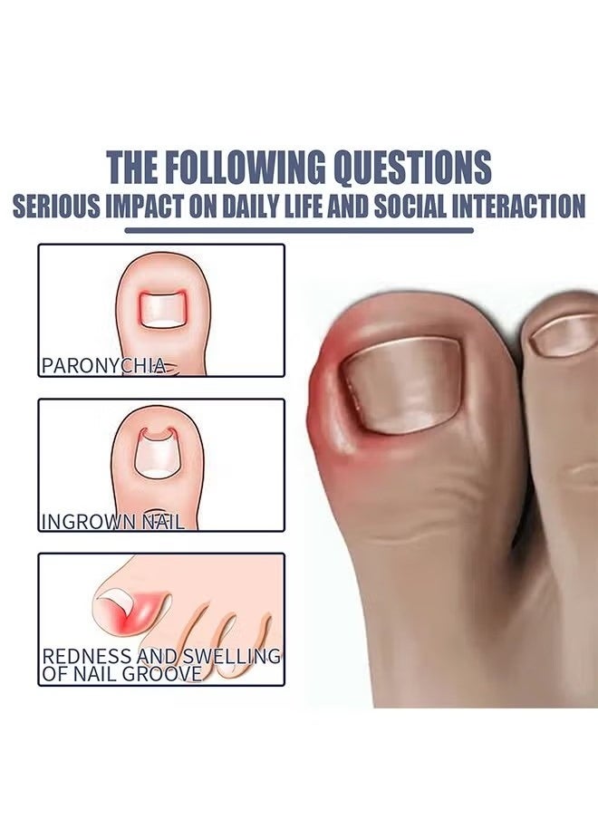 West&Month Removal Paronychia Oil- Ingrown Toenail Nail Repair Toenail Plus Anti Paronychia Relief Oil Nail Renewal Liquid for Damaged and Discoloration Nail Swelling and Pain removal Oil  - Image 4