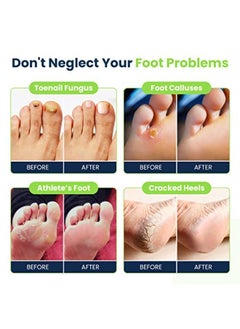 Foot Cure Oil Foot Soak With Epsom Salt - Made In Usa - For Foot Odor, Toenail Fungal, Athletes Foot, Softens Calluses & Soothes Sore Tired Feet, Pedicure Spa At Home - 16Oz  - Image 5
