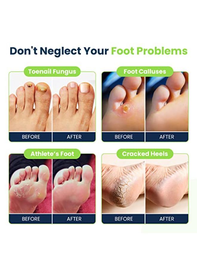 Foot Cure نقع القدم بالزيت مع ملح إبسوم - صنع في الولايات المتحدة الأمريكية - لرائحة القدم، وفطريات أظافر القدم، والقدم الرياضية، وتليين مسامير القدم وتسكين آلام القدمين المتعبة، وباديكير سبا في المنزل - 16 أونصة  - Image 5