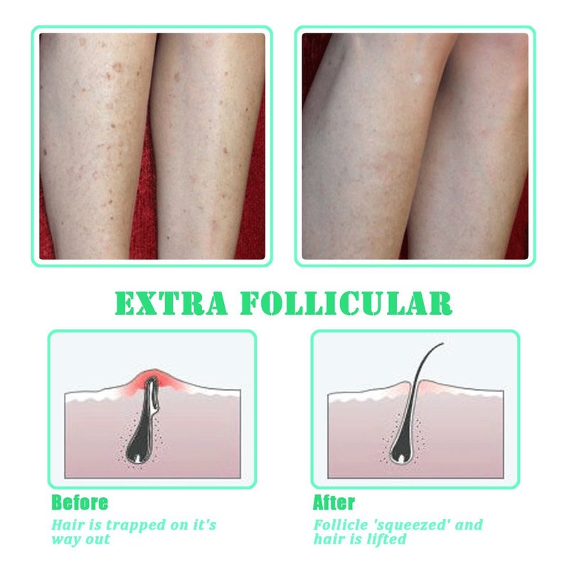 TailaiMei Exfoliating Brush for Ingrown Hair Treatment - to Treat and Prevent Bikini Bumps, Razor Bumps - Silky Smooth Skin Solution for Men and Women - Image 3