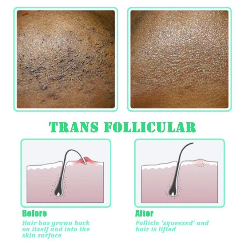 TailaiMei Exfoliating Brush for Ingrown Hair Treatment - to Treat and Prevent Bikini Bumps, Razor Bumps - Silky Smooth Skin Solution for Men and Women - Image 4