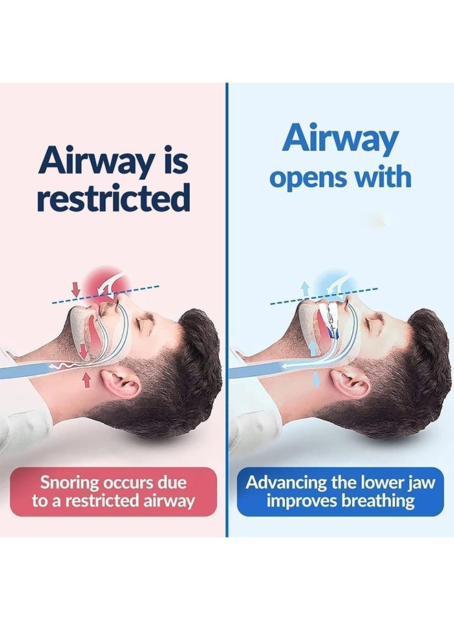 JS Anti Snoring Devices Mouthpiece, Stop Snoring Adjustable Snoring Mouth Guard, Improve Sleep Quality, Adjustable Mouth Type Silicone Anti Snoring Device, Anti Grinding Braces Snoring Device - Image 5