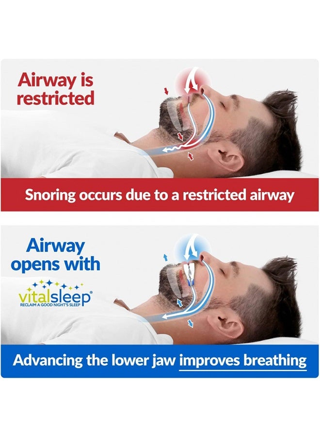 JS Anti Snoring Devices Mouthpiece, Stop Snoring Adjustable Snoring Mouth Guard, Improve Sleep Quality, Adjustable Mouth Type Silicone Anti Snoring Device, Anti Grinding Braces Snoring Device - Image 3