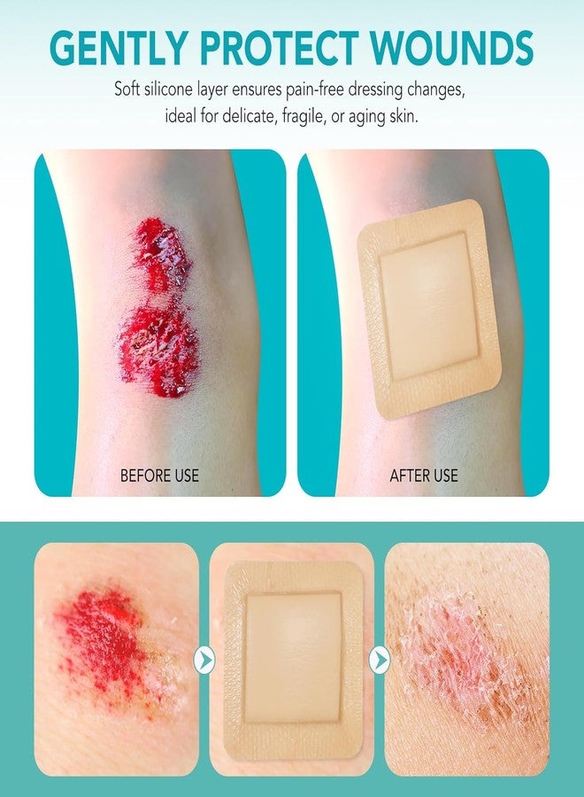 BOXANIA ضمادات رغوية من السيليكون 10 × 10 سم معقمة، 5 قطع، ضمادات جروح مع حواف لاصقة من السيليكون المقاوم للماء واللطيف، وسادات فائقة الامتصاص وجيدة التهوية (عبوة من 5 قطع). - Image 2