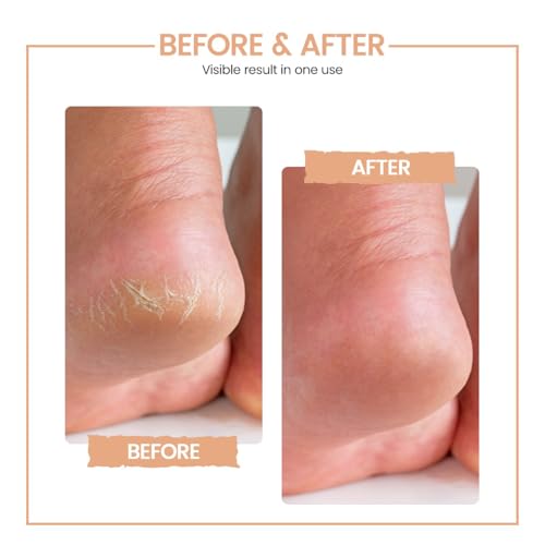 PROTOUCH Bliss Callus Remover | Rechargeable Electric Foot Scrubber for Dead Skin & Cracked Heels | 3 Roller Heads, 2 Speeds | Professional Pedicure Tool | 1 Year Doorstep Warranty - Image 5