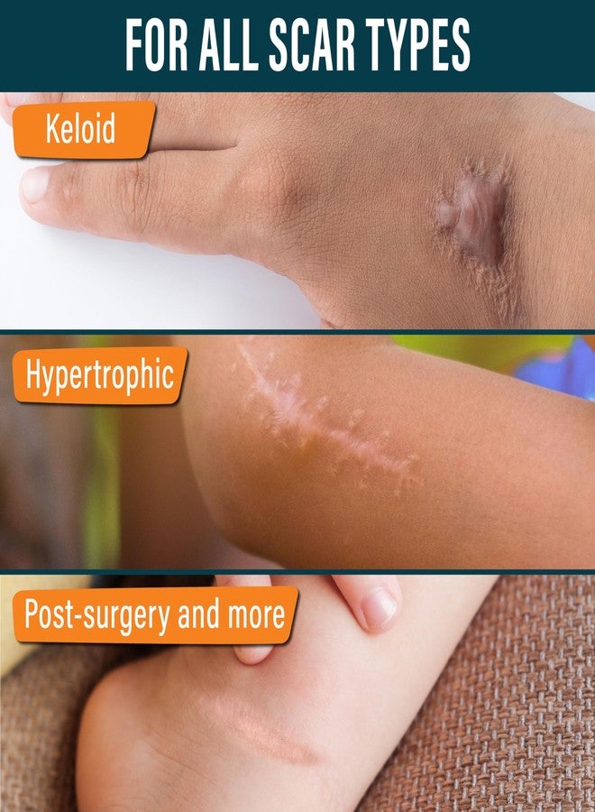 نوفاديرميس شريط ندبات السيليكون من نوفاديرميس للأطفال - شريط ندبات للندبات الجراحية - لفة 120 بوصة × 1.5 بوصة - شريط ندبات سيليكون طبي قابل لإعادة الاستخدام للأطفال - عبوة واحدة - ديناصورات - Image 3