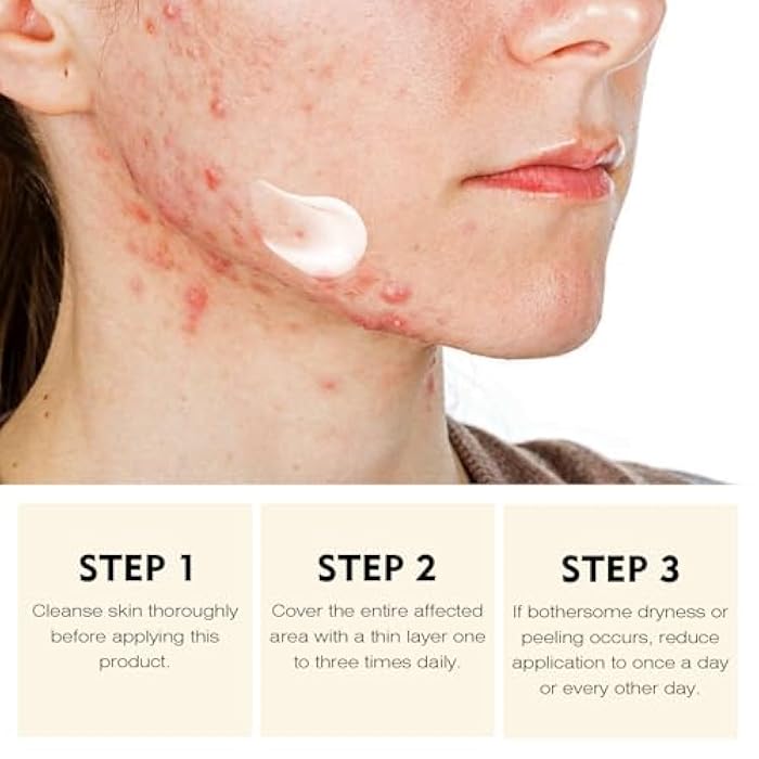 YAFUSIPE Acne Treatment for Face for Hormonal Cystic Stubborn Acne Cream for Sensitive Skin Teens Adults Women Men Spot Pimple Butt Control Rapid Clearing Breakout Overnight Face Blemish Treatment - Image 4