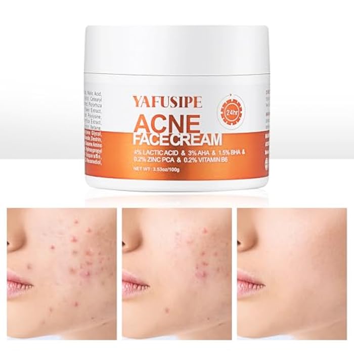 YAFUSIPE Acne Treatment for Face for Hormonal Cystic Stubborn Acne Cream for Sensitive Skin Teens Adults Women Men Spot Pimple Butt Control Rapid Clearing Breakout Overnight Face Blemish Treatment - Image 1