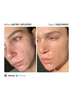 Qure Qure Skincare Micro-Infusion System | At-Home Microneedling Facial | 24K Gold 0.5mm Needles | Hydrating & Anti-Aging Serums | Pore-Minimizing, Collagen-Boosting & Skin Rejuvenating | 3-Month Supply  - Image 4