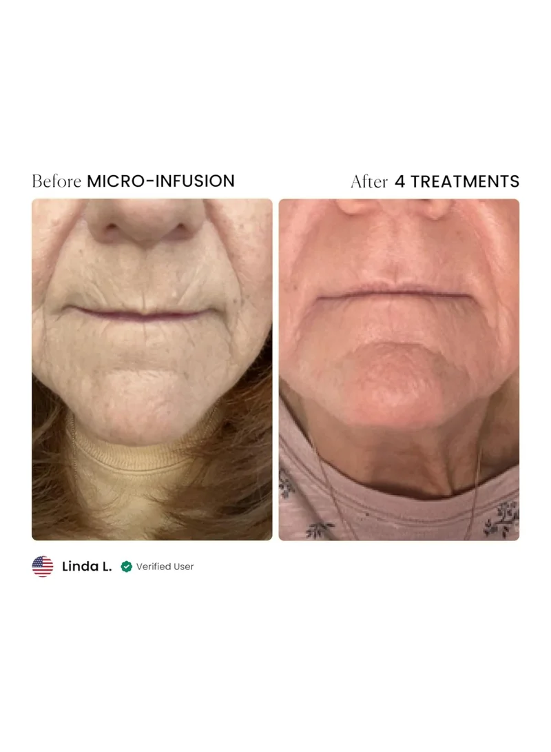 Qure Qure Skincare Micro-Infusion System | At-Home Microneedling Facial | 24K Gold 0.5mm Needles | Hydrating & Anti-Aging Serums | Pore-Minimizing, Collagen-Boosting & Skin Rejuvenating | 3-Month Supply