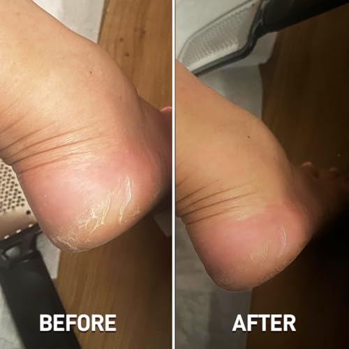 Multibrite Foot Filer Scrubber For Dead Skin Removal, Professional Callus Remover, Foot Care Products & Cleaner For Smooth Feet, Effective Hard Skin Eliminator, Essentials Pedicure Foot Tools - Image 5