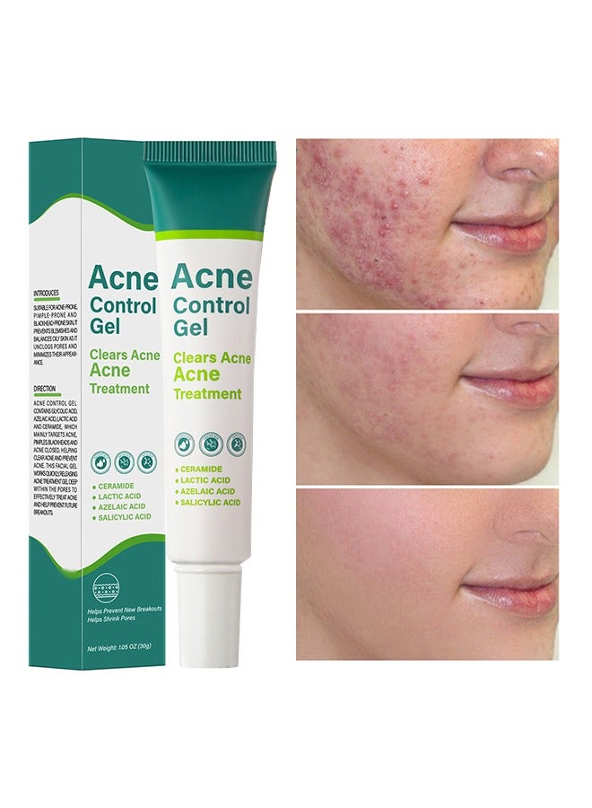 MOOYAM Acne Control Gel，Clears Acne, Acne Treatment Cream,Acne Spot Treatment gel,Clear Acne Spot Treatment Gel,Pimple Cream for Acne Prone Skin Care,Acne Control Gel,Salicylic Acid Acne Treatment Gel,Clear Breakouts, 30g  - Image 1