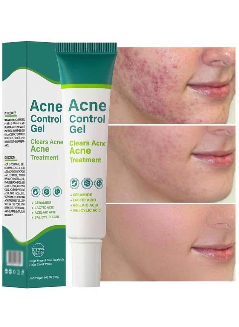 MOOYAM - Acne Treatment Cream,Acne Spot Treatment gel,Clear Acne Spot Treatment Gel,Pimple Cream for Acne Prone Skin Care,Acne Control Gel,Salicylic Acid Acne Treatment Gel,Clear Breakouts, 30g - Image 1
