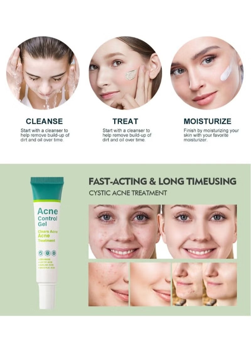 MOOYAM - Acne Treatment Cream,Acne Spot Treatment gel,Clear Acne Spot Treatment Gel,Pimple Cream for Acne Prone Skin Care,Acne Control Gel,Salicylic Acid Acne Treatment Gel,Clear Breakouts, 30g - Image 1
