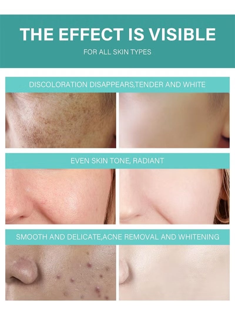 MOOYAM - Acne Treatment Cream,Acne Spot Treatment gel,Clear Acne Spot Treatment Gel,Pimple Cream for Acne Prone Skin Care,Acne Control Gel,Salicylic Acid Acne Treatment Gel,Clear Breakouts, 30g - Image 1