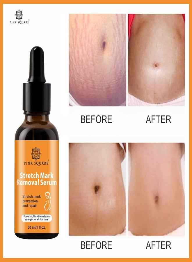 Pink Square Stretch Marks Removal Serum | Reduces Stretch Marks, Soothes Dry & Itchy Skin, Improves Skin Texture & Tone | For Men & Women | Pack of 4x30ML Each - Image 5