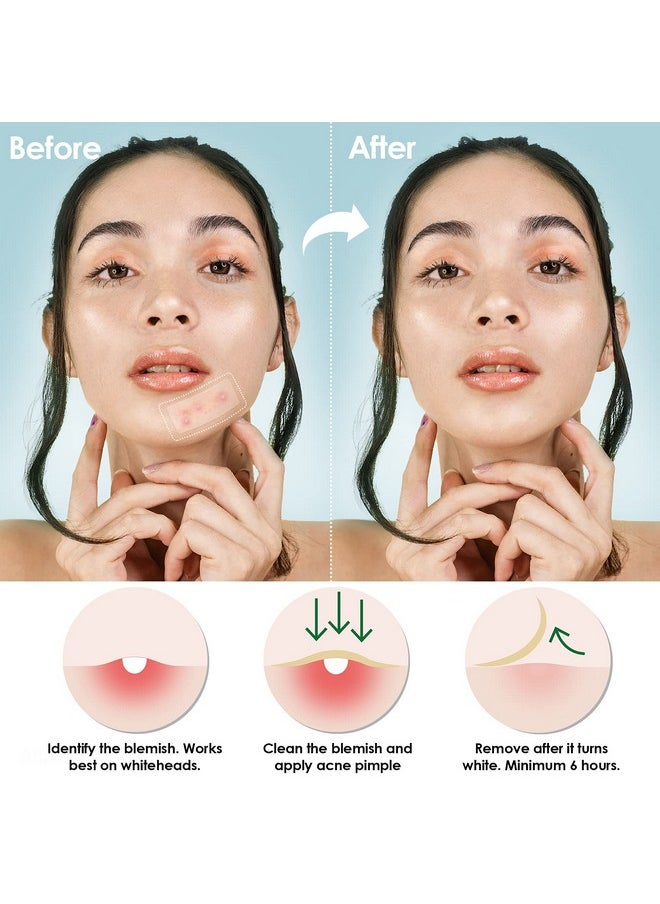 NiHealth Large Tea Tree Oil Acne Pimple Patch Absorbing Hydrocolloid Spot Transparent Matte Blemish Cover For Face Body Skin 25Mm&60Mm (10 Counts)  - Image 5