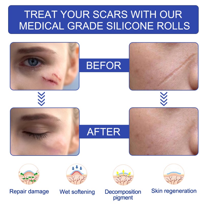 Silicone Scar Sheets 3M Soft Silicone Gel Scar Tape Painless Silicone Tape Roll - Reusable, Medical Grade Silicone Scar Removal Strips for C-Section & Keloid Surgery, Burn, Acne - Image 4