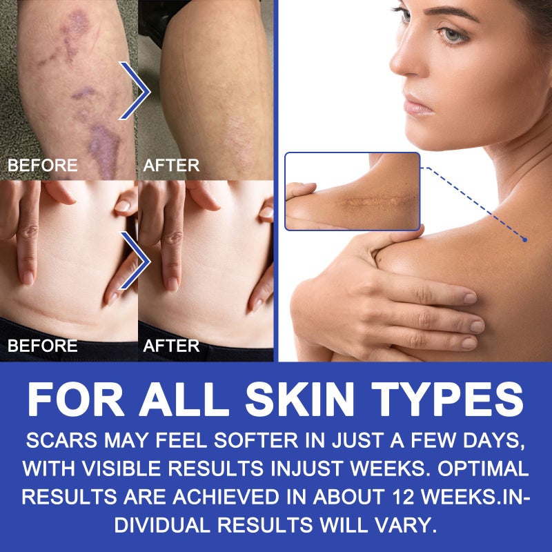 Silicone Scar Sheets 3M Soft Silicone Gel Scar Tape Painless Silicone Tape Roll - Reusable, Medical Grade Silicone Scar Removal Strips for C-Section & Keloid Surgery, Burn, Acne - Image 5