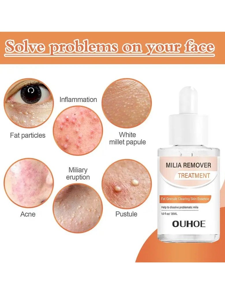 OUHOE - Milia Clearing Essence, Fat Granules Removal Eye Serum, Natural Formula Milia Remover Milia Spot Treatment, Anti Dark Circle Fade Fine Essence, Anti Puffiness Moisturizing Skin Care Serum - Image 1