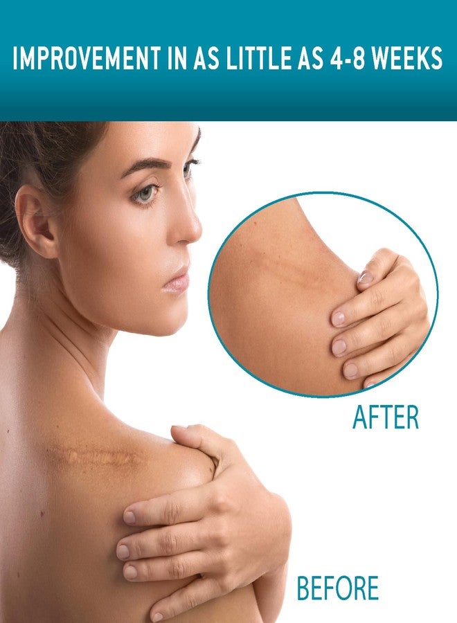Care Science Silicone Scar Tape 1.6 x 120in 1ct | Scar Tape for reducing the appearance of scars - Image 2