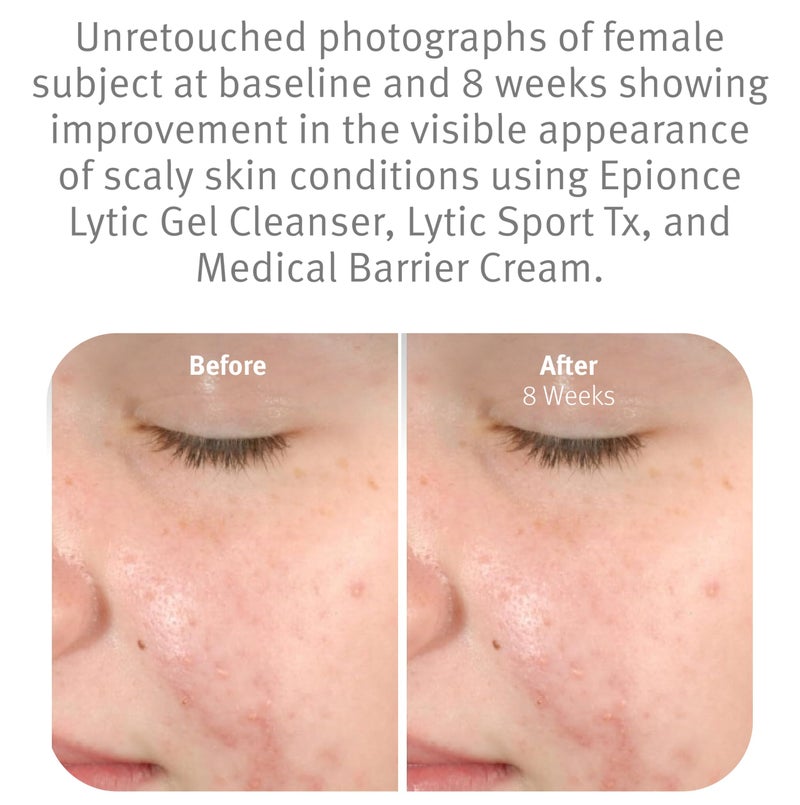 Epionce Lytic Gel Cleanser â€“ Gentle Foaming Face Wash & Makeup Remover | For Oily, Combination & Problem Skin | Acne & Oil-Control Cleanser with Willow Bark | Dermatologist Skincare - Image 4