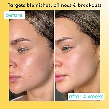 Super Facialist Pore Clarity Daily Exfoliator Acne Treatment Blackhead Remover Exfoliator with 1 Niacinamide Tea Tree Oil Prebiotics Vegan Friendly 150ml - Image 4