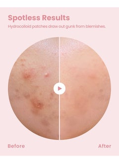 Glam Up Hydrocolloid Blemish Pimple Zit Patches - Invisible Ultra Thin Spot Cover Stickers for Face and Skin, Strong Water-proof and Adhesive Overnight, Vegan-friendly (36 Count / 2 Sizes)  - Image 3