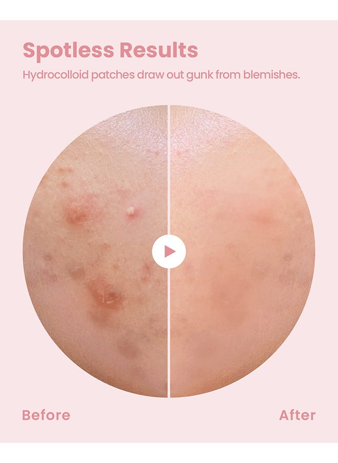 Glam Up - Hydrocolloid Blemish Pimple Zit Patches - Invisible Ultra Thin Spot Cover Stickers for Face and Skin, Strong Water-proof and Adhesive Overnight, Vegan-friendly (36 Count / 2 Sizes) - Image 1