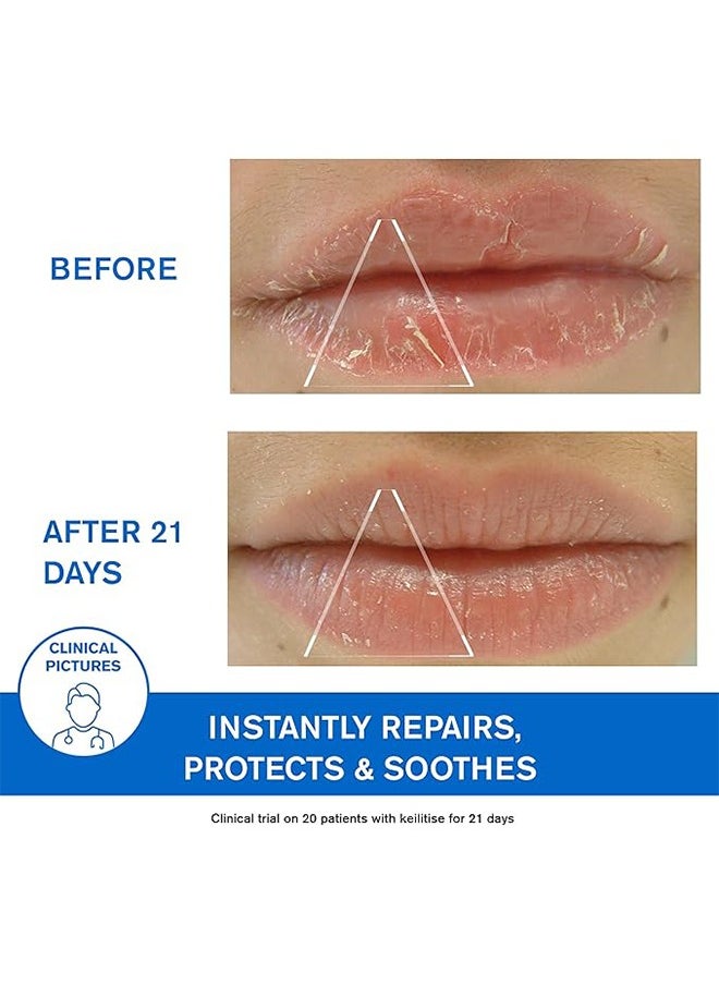 يورياج بلسم شفاه مجدد باریدرم سيكا ، مهدئ فوري للشفاه المجففة ، مهدئا جوهر الشفاه 15ml  - Image 3