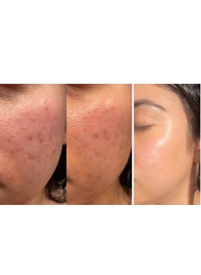 Anua Wonder 10% Niacinamide+ 4% Tranexamic Acid Serum With New Look 30ml + Azelaic Acid 10 Hyaluron Redness Soothing Serum 30ml - Image 4