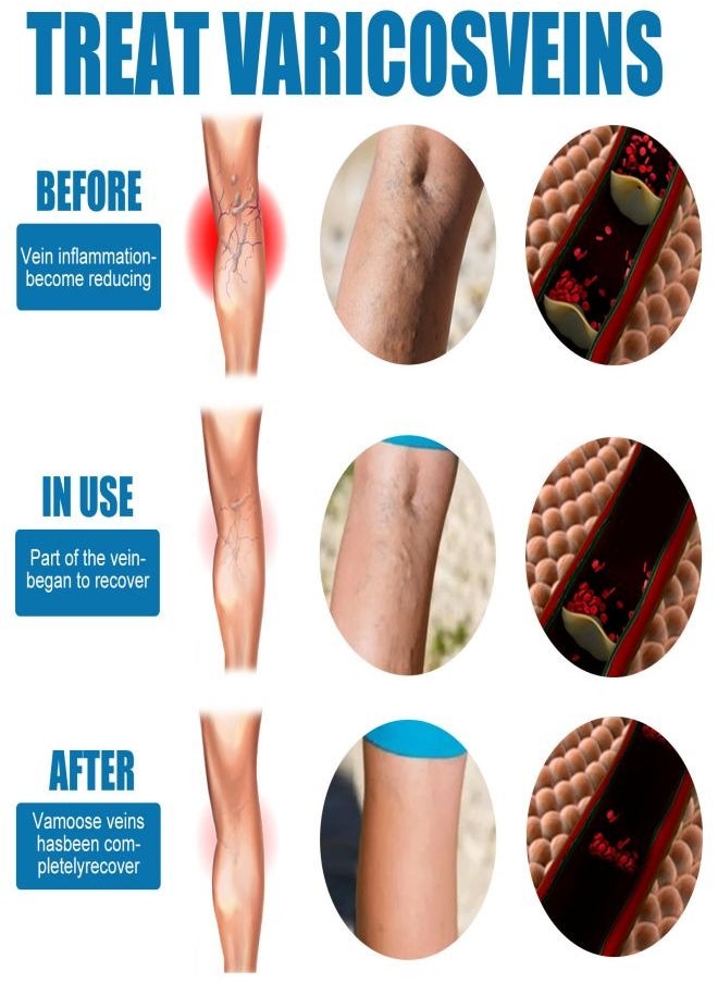 SOUTH MOON - Treatment of varicose veins spray, vein healing spray. - Image 1