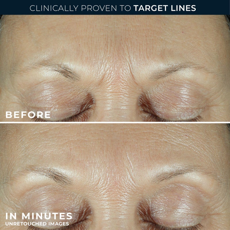 RoC Derm Correxion Fill + Treat Advanced Retinol Serum, Wrinkle Filler Treatment with Hyaluronic Acid for Crow's Feet, 11 Wrinkles, & Laugh Lines, (.5 fl oz) with Retinol Packette (Packaging May Vary) - Image 5