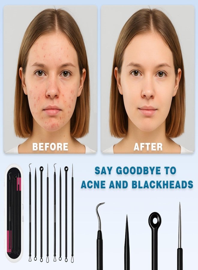 Brvlsoc Blackhead Remover Tool Kit – 4-Piece Stainless Steel Acne & Pimple Set | Whitehead & Zit Extractor with Non-Slip Handles （2 Sets） - Image 4