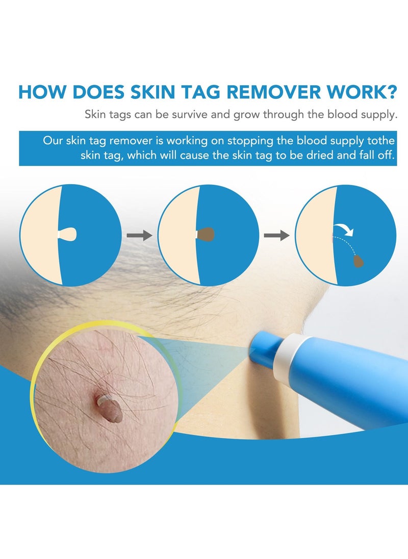 Sefudun Wart Removal Tool Skin Tag Removal Double Head Blue  - Image 3